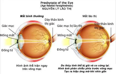 LÃO THỊ - NGUYÊN NHÂN, TRIỆU CHỨNG VÀ CÁC PHƯƠNG PHÁP ĐIỀU TRỊ